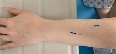 Case Report: Upper limb superficial venous thrombosis associated with oral contraceptives mimicking soft tissue mass